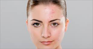 ACNE AND ITS HOMOEOPATHIC TREATMENT