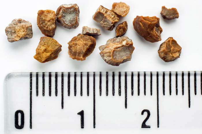 HOMEOPATHIC MEDICINES IS EFFECTIVE FOR KIDNEY STONE
